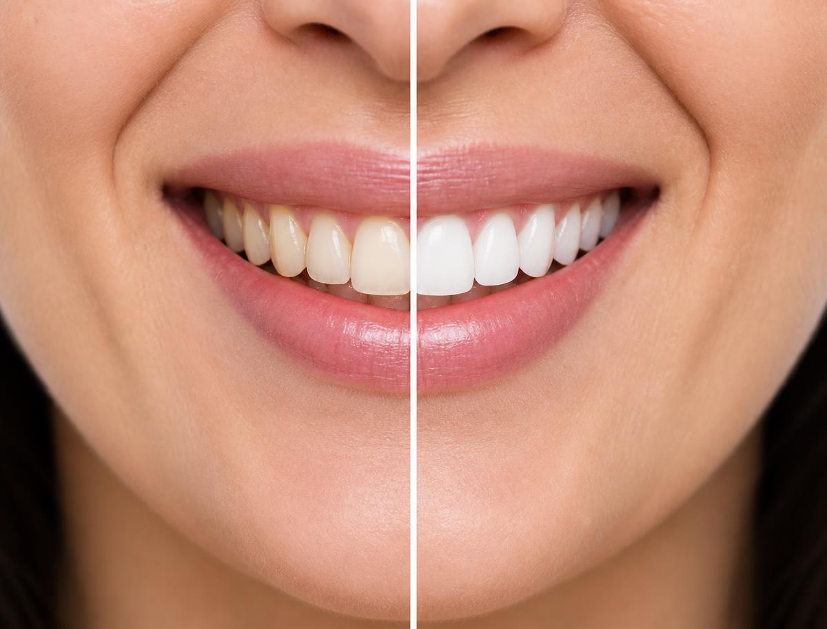 Comparação ilustrativa de dentes antes e depois do clareamento dental — exemplo 1